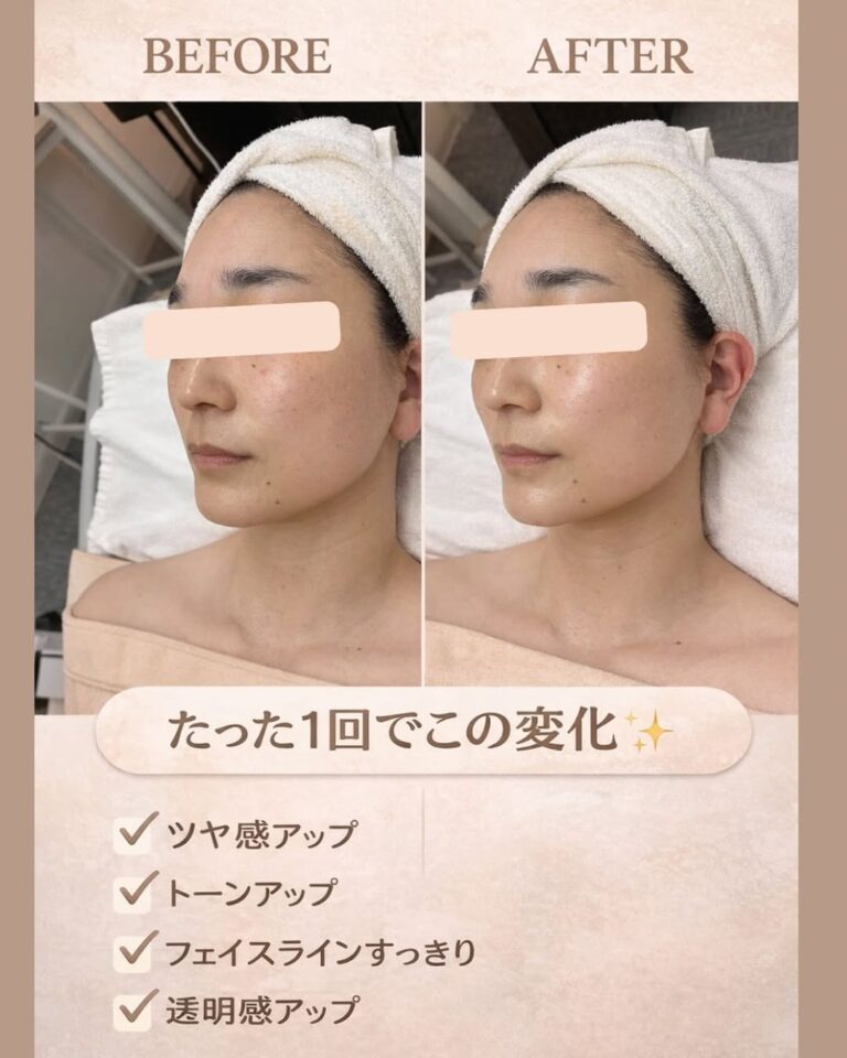 インディバフェイシャル1回の変化